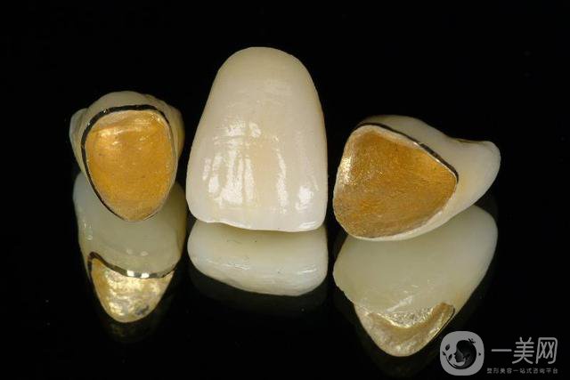 黃金烤瓷牙價格一般是多少？