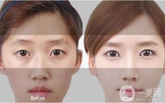 埋線雙眼皮好不好？埋線雙眼皮*果圖