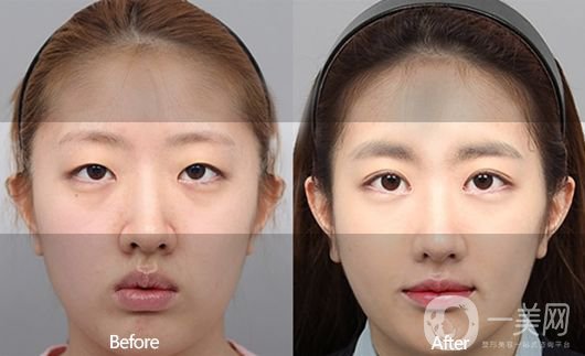 埋線雙眼皮好不好？埋線雙眼皮*果圖