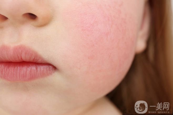 臉上很多紅血絲怎么辦？給你1個(gè)小法寶和紅血絲說(shuō)再見(jiàn)