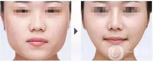 打*前后*果圖 *的價(jià)格是多少