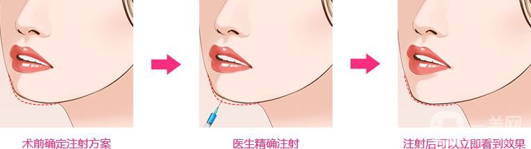 墊下巴前后圖 墊下巴的手術(shù)方式