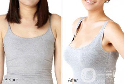 解放軍455整形外科隆胸手術(shù)做的怎么樣 