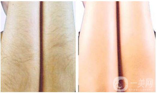 激光脫毛有什么好處？