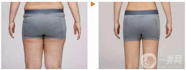 吸脂手術(shù)類型有哪些？