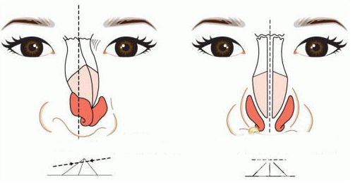 歪鼻矯正手術(shù)多少錢 歪鼻矯正*果怎么樣