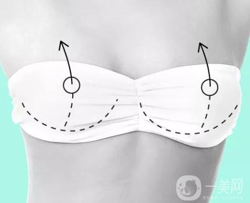 隆胸多少錢？術(shù)后有哪些注意事項？