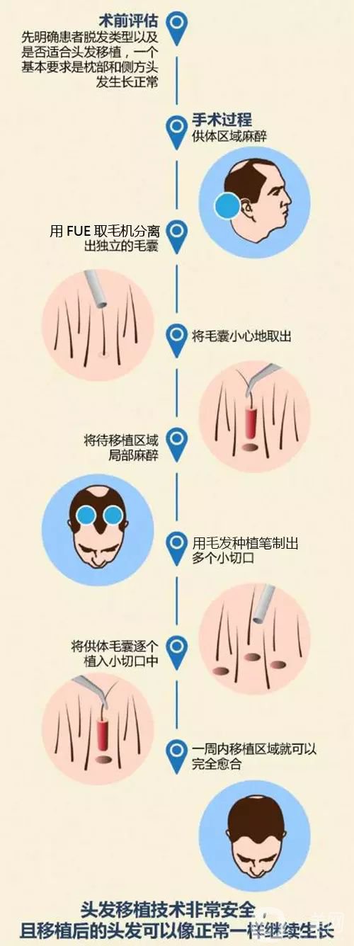 毛發(fā)移植*果怎么樣？毛發(fā)移植原理是什么？