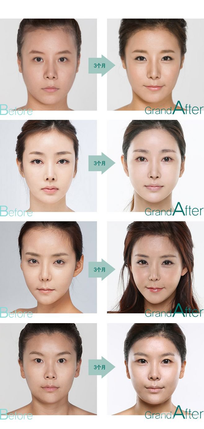 毛發(fā)移植*果怎么樣？毛發(fā)移植原理是什么？