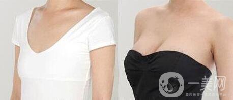 自體脂肪隆胸手術多少錢 *嗎？