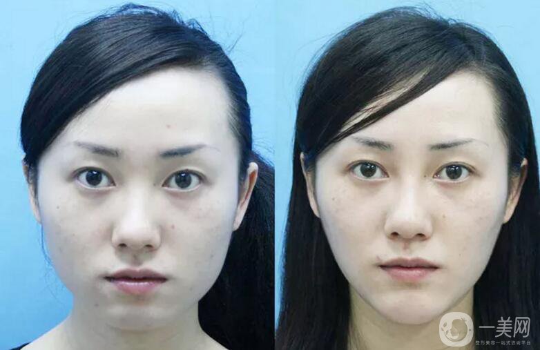 下頜角磨骨整形價格貴嗎？需要多少錢？