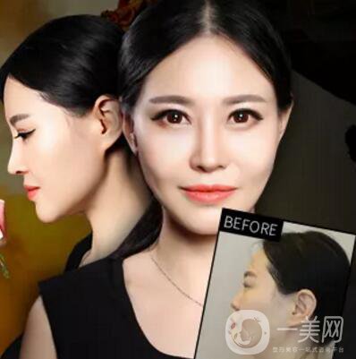 隆鼻手術(shù)一般多少錢(qián)？?jī)r(jià)格高不高？