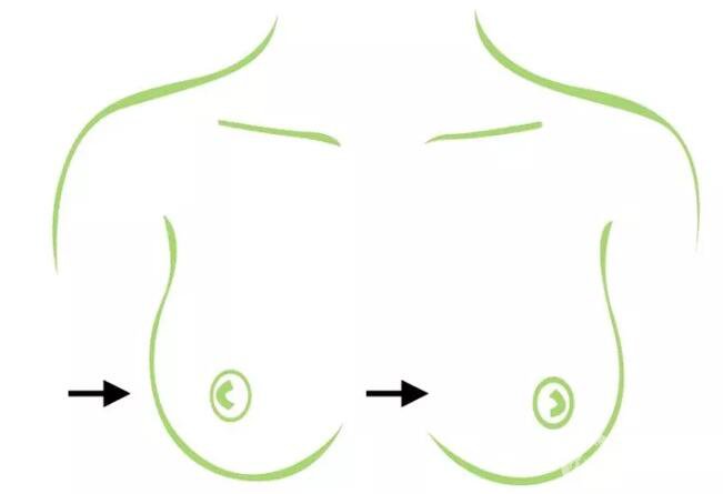 水滴隆胸*果圖 水滴隆胸好不好