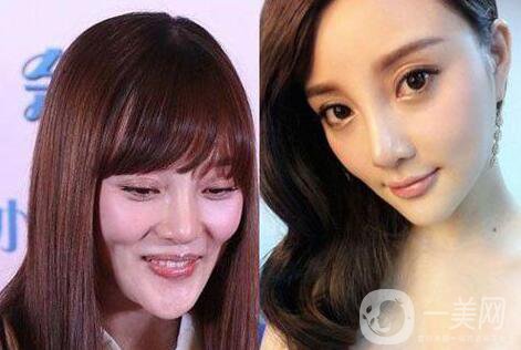 又一個(gè)整容失敗的女明星，鼻子都整歪了，不甘心揚(yáng)言還要植發(fā)！