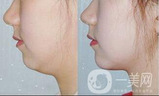 深圳雙下巴吸脂價格,雙下巴吸脂多久恢復
