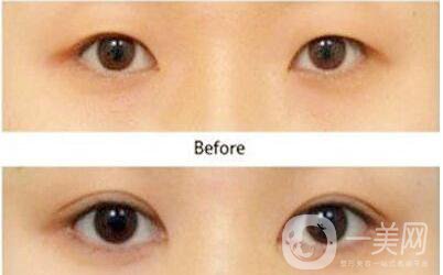 割雙眼皮術后護理 雙眼皮手術方法