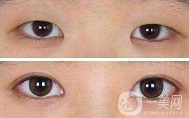 割雙眼皮哪家*好 割雙眼皮的方式有哪些