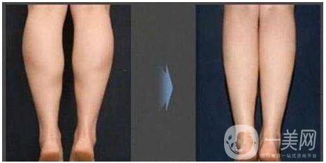 瘦小腿有什么*的好方法？