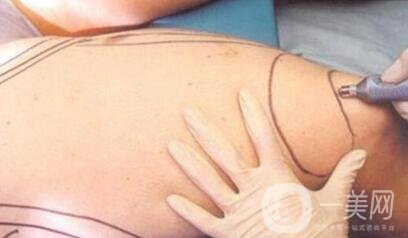 【科普】吸脂減肥常見的并發(fā)癥有哪些？怎么樣*避免呢？