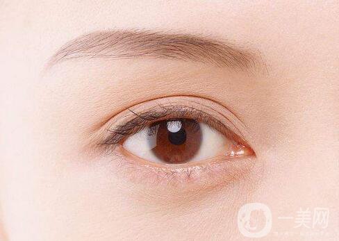 雙眼皮手術恢復時間-雙眼皮術后注意事項