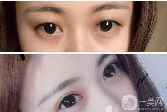 雙眼皮術后注意事項