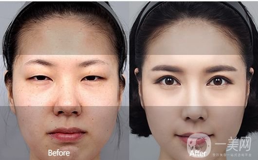 一般割雙眼皮多少錢(qián)？影響價(jià)格的因素有哪些？