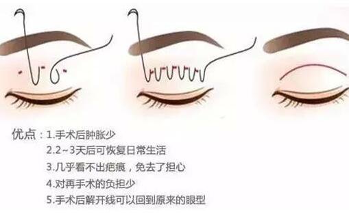 做埋線雙眼皮術后多久恢復 注意事項是什么