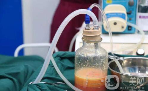 “吸脂減肥"手術前，你需要知道這些小常識 