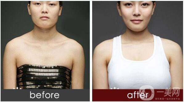 假體隆胸材料圓形和水滴形有什么區(qū)別？