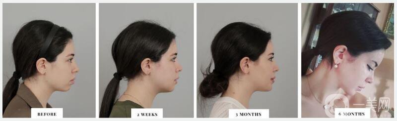 面部輪廓手術(shù)的恢復(fù)時(shí)間及注意事項(xiàng)講解