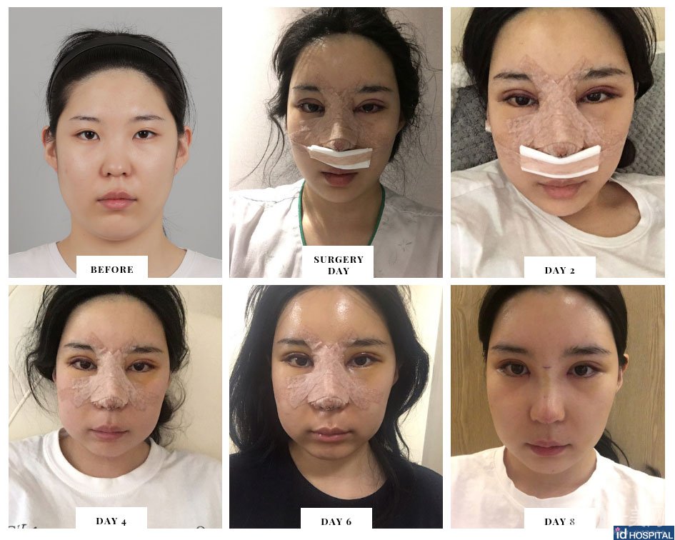 *+雙眼皮手術(shù)術(shù)后恢復(fù)日記