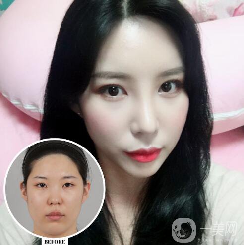 *+雙眼皮手術(shù)術(shù)后恢復(fù)日記