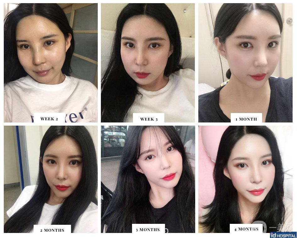 *+雙眼皮手術(shù)術(shù)后恢復(fù)日記