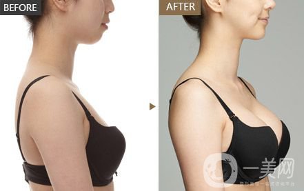 隆胸的材料有哪些？手術方式有哪些呢？】