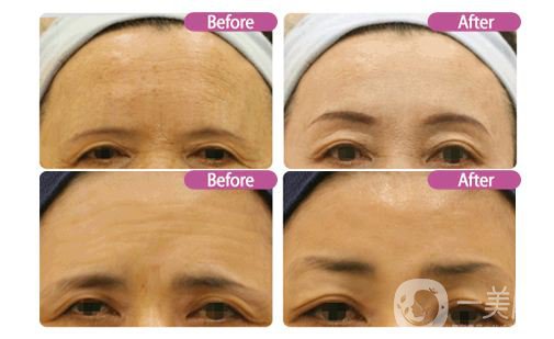 注射伊維蘭除皺后應(yīng)該要注意哪些問題呢?