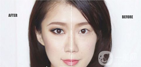 重慶做雙眼皮要多少錢 割雙眼皮喲風(fēng)險(xiǎn)嗎