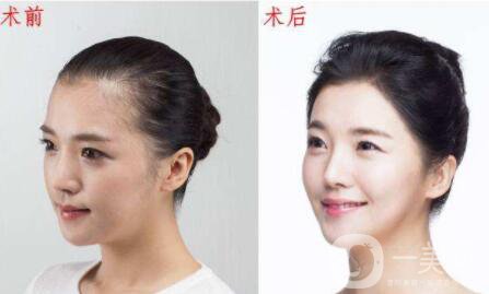 班加羅爾的毛發(fā)移植怎么樣,價格,*果好不好