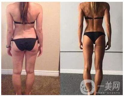 吸脂術(shù)后注意事項(xiàng)