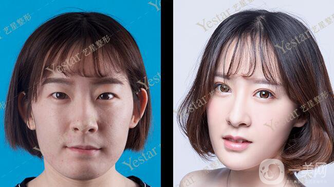 *前后 *手術(shù)*果如何？