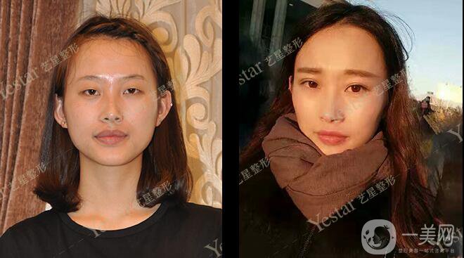 *前后 *手術(shù)*果如何？