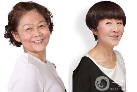 祛皺多少錢 祛皺紋有什么副作用嗎