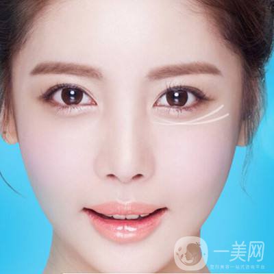 深圳去眼袋手術(shù)多少錢 去眼袋有什么風(fēng)險嗎？