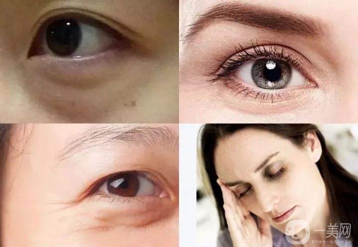 深圳去眼袋手術(shù)多少錢 去眼袋有什么風(fēng)險嗎？