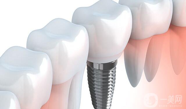 深圳種植牙價格,深圳種植牙多少錢