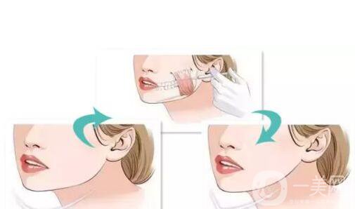 *一針要多少錢(qián) *的藥*是*的嗎