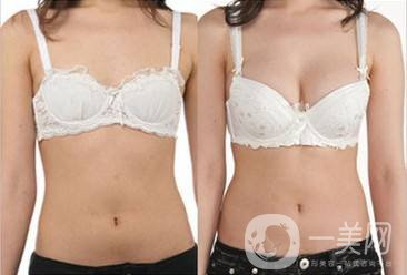 沃斯堡豐胸術(shù)怎么樣 隆胸的風(fēng)險有多大？