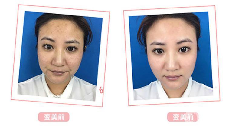 光子嫩膚*果介紹？對(duì)皮膚會(huì)有傷害嗎？