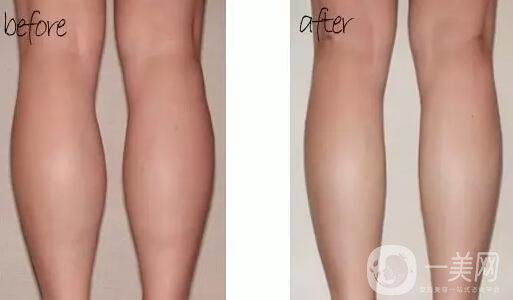 **多少錢 有副作用嗎 需要注射幾次？