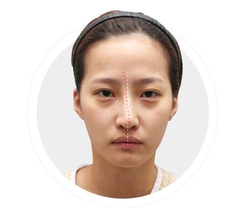 北京鼻骨矯正術(shù)多少錢 鼻骨矯正會(huì)留疤痕嗎