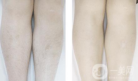 激光脫毛怎么樣 激光脫毛的工作原理